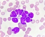 New therapeutic target for patients with acute myeloid leukemia