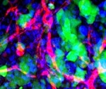 Immune cells leave traces on metastasis in the brain, likely to help future treatments