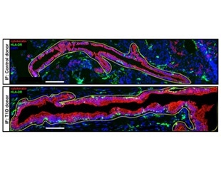 Researchers discover how pancreatic cells remodel themselves to reduce the immune response in patients at risk for T1D