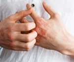 Investigating the Relationship Between Food Allergies and Eczema