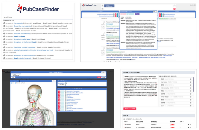 Researchers make significant improvements to PubCaseFinder, the clinical decision support system