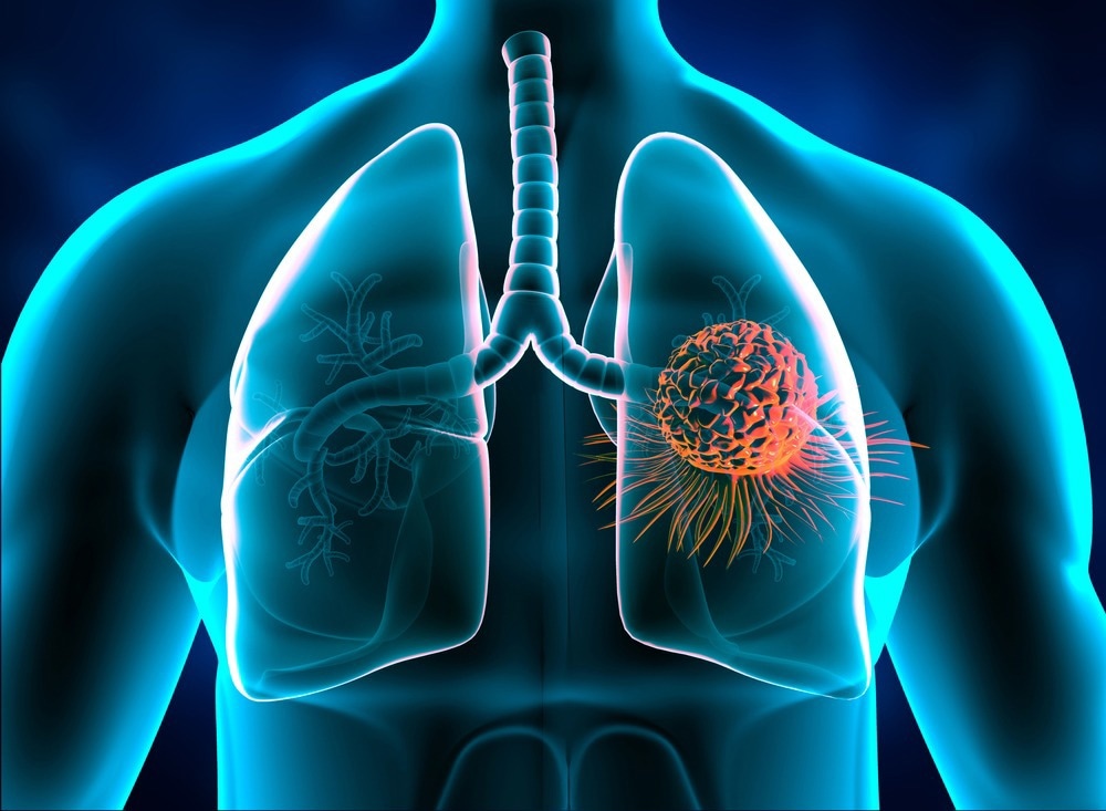 Lung Cancer Concept