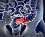 Three-year interval appropriate between screening for colorectal cancer