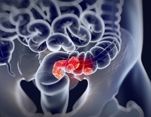 Three-year interval appropriate between screening for colorectal cancer