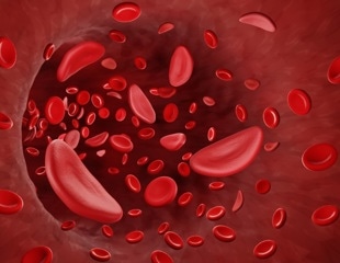 Sickle Cell Disease Cure? Prime Editing Offers Hope for Blood Disorder