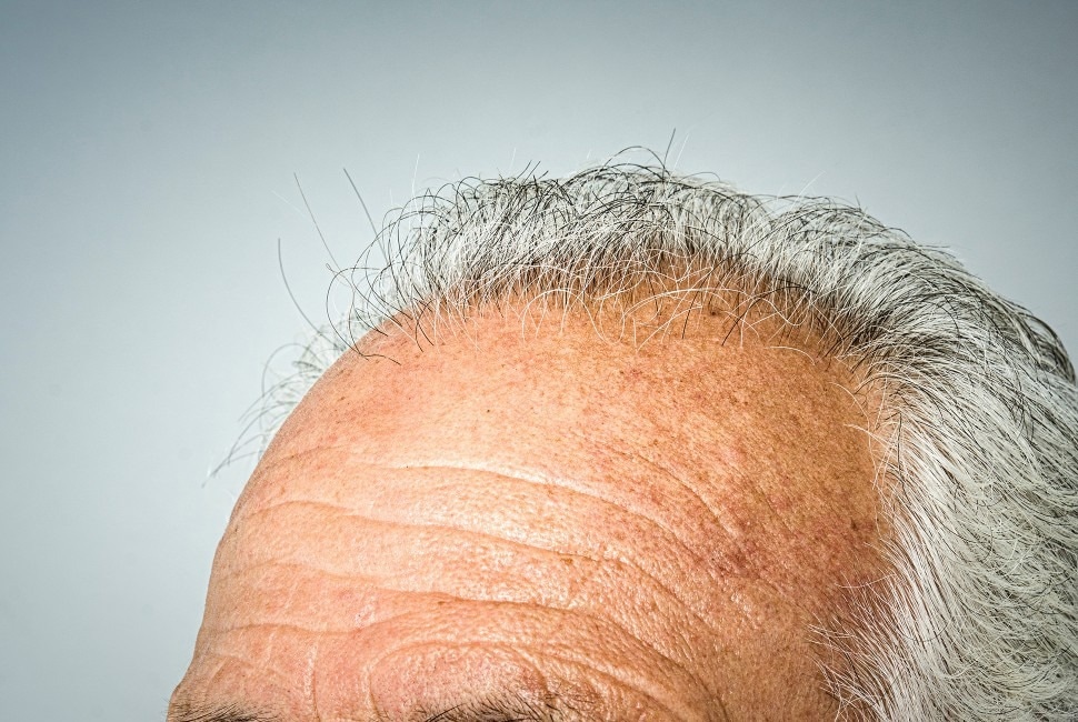 Hair Regrowth with Softening Stiff Hair Follicle Stem Cells with microRNA