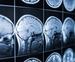 New Computational Methods for Improving Alzheimer’s Disease Characterization